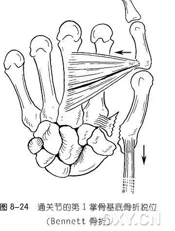 几种严重骨折医学名称,常见的骨折有哪些名称
