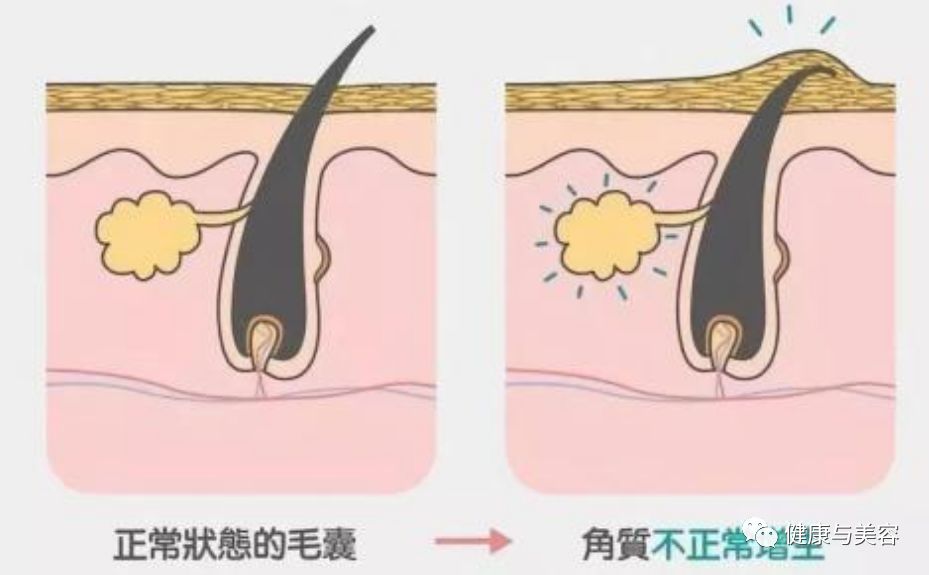 38岁阿娇沉迷于祛痘、去黑头的教学，居然很实用