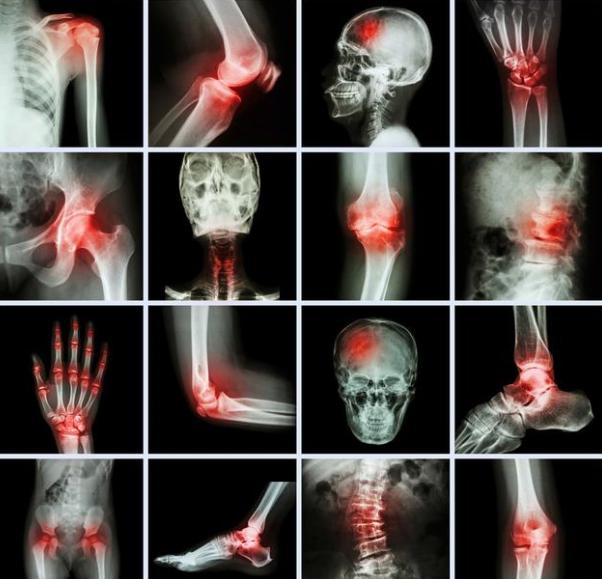 治疗骨质疏松最有效的方法是什么,治疗骨质疏松的正确的方法是什么