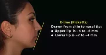 凹面型侧脸怎么改善,凹面型侧脸是怎么造成的