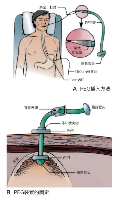 胃造瘘术后的护理方法图片,胃造瘘日常护理视频
