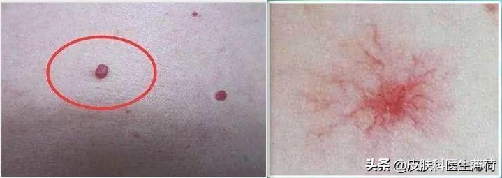 孕期长痘皮肤救星可以用吗,孕期皮肤泛红长痘用什么都没用