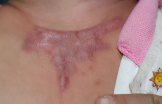 烧烫伤疤痕去除最好办法,烧烫伤疤痕怎么修复