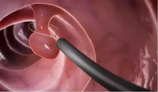 肠镜检查发现息肉应该怎么办,肠镜检查出息肉会当场割掉吗