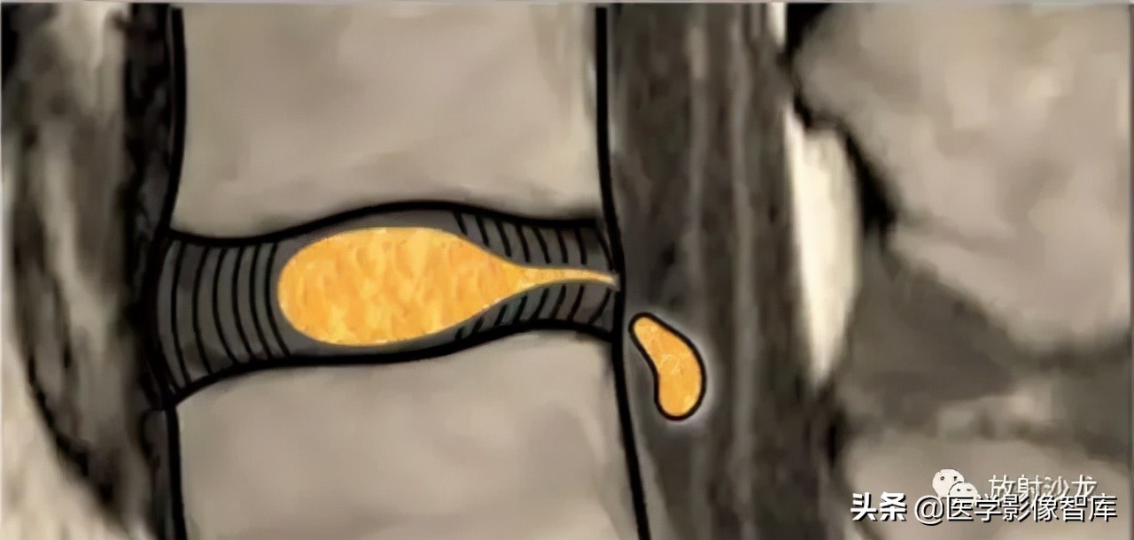 一键收藏所有的内容,颈椎间盘病变的症状和治疗