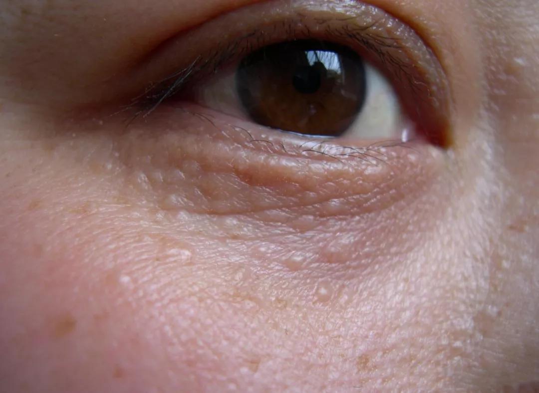 你以为的脂肪粒其实是肿瘤,脂肪粒会转变成癌吗