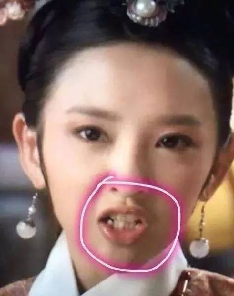 明星都做了全烤瓷牙吗,明星做烤瓷牙是要拔掉原来的牙吗