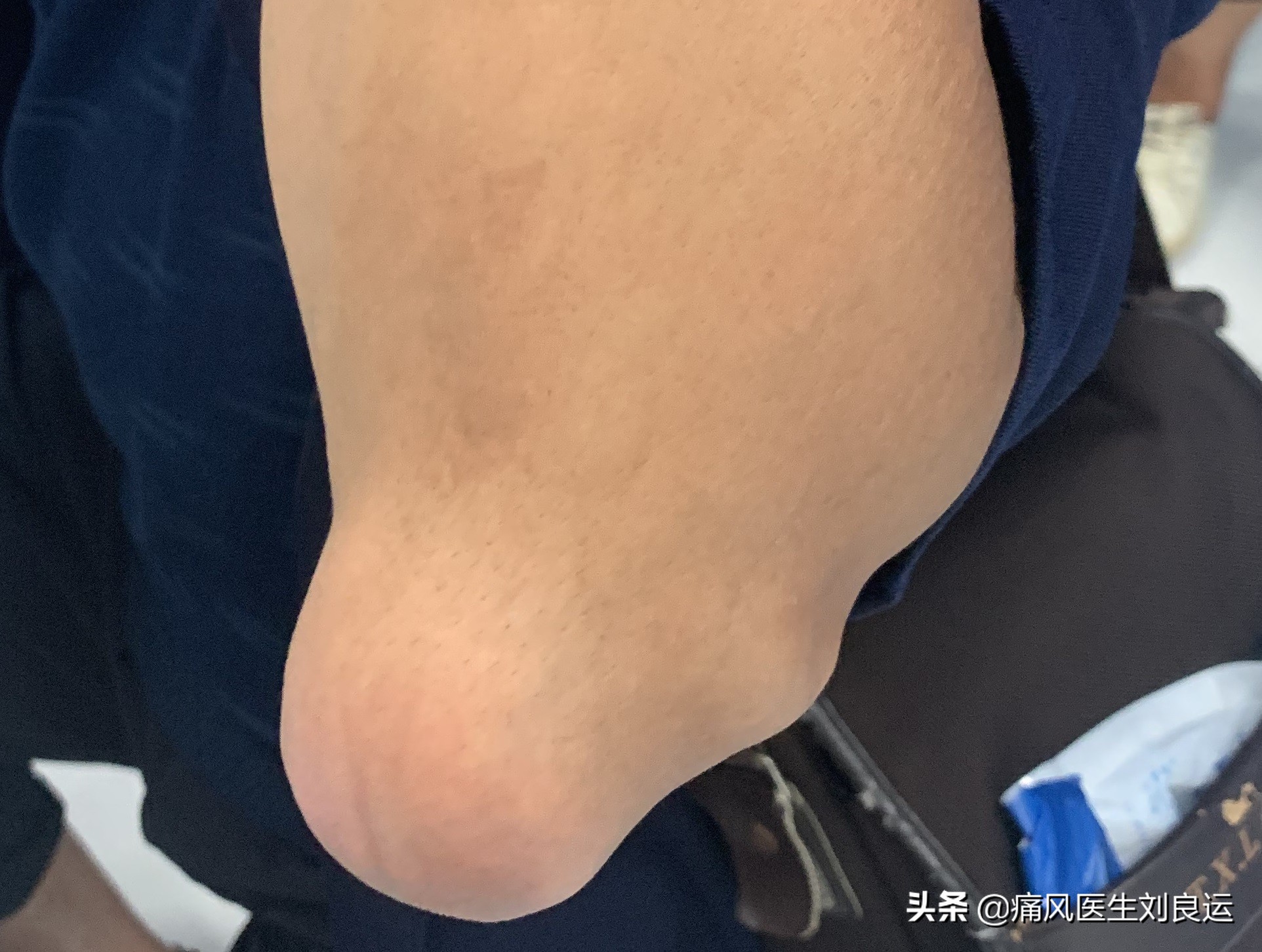 痛风发作怎么避免有痛风石,痛风长石头吗