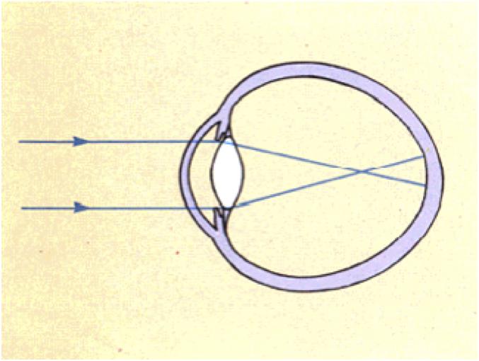近视如何矫正能防止遗传,近视如何矫正视力下降