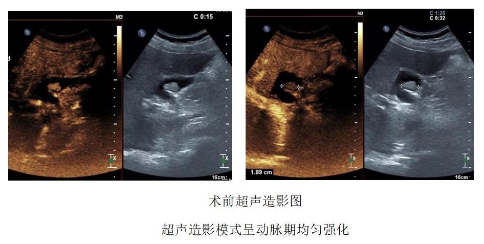 胆囊息肉消融保胆有效吗,胆囊息肉消融保胆有用吗