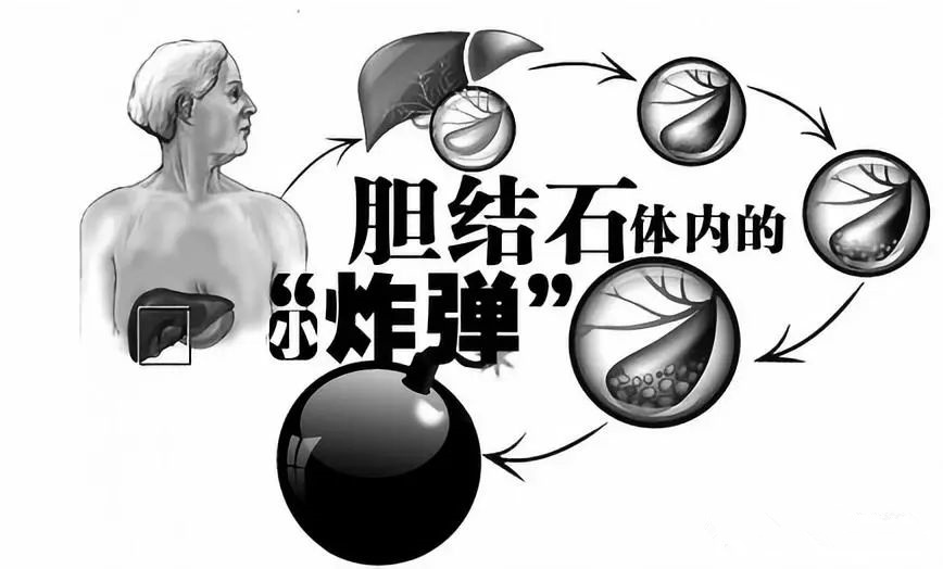 春天为什么胆结石会发作,胆结石疼痛一招解决