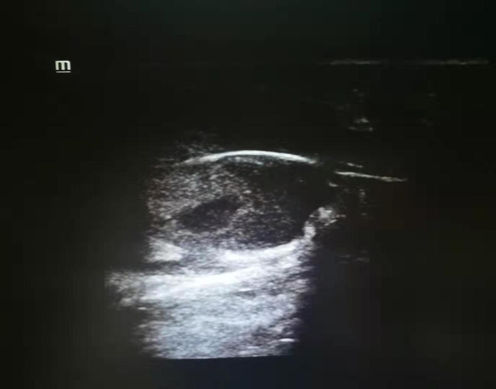 久坐屁股上长了一个脓包涂什么药,屁股上长了一个特大脓包