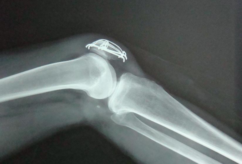 膝盖积水是怎么导致的,膝盖为何积水