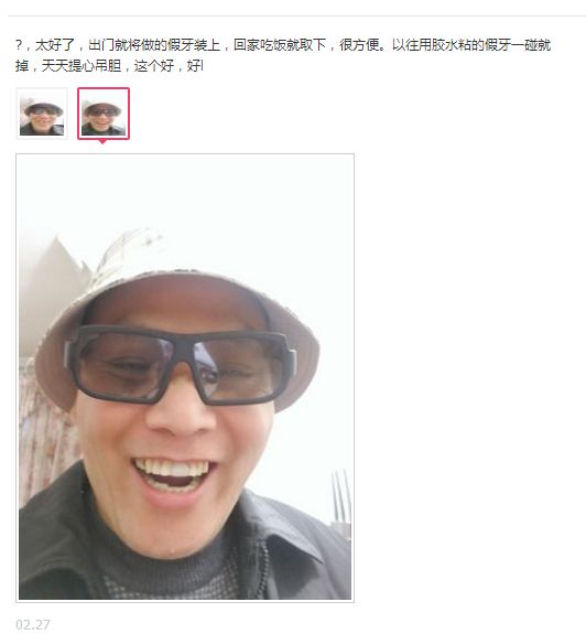 做一颗临时牙教程,自制隐形牙