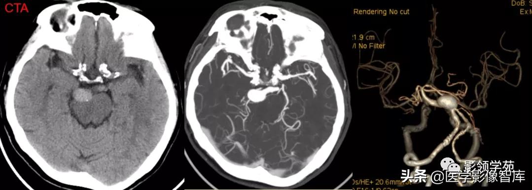 鞍区肿瘤做什么检查得出来,鞍区肿瘤的影像学鉴别