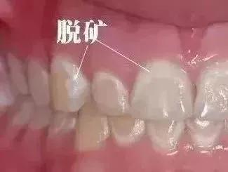 牙齿上出现白斑是怎么回事,牙齿上有白斑是什么原因
