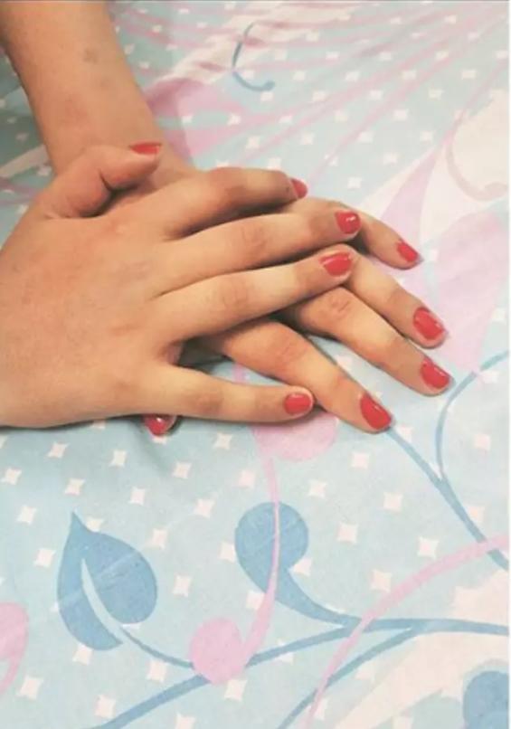 印度少女移植男性黝黑双手，肤色神奇变白，嫩滑无毛如纤纤玉手