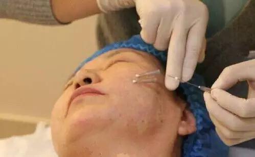 线雕隆鼻取出来要多少钱,线雕隆鼻8000