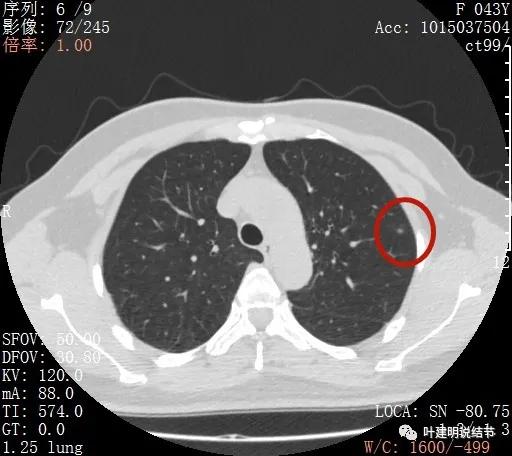 怎样从病理报告看是不是原位癌,原位腺癌切除子宫要开刀吗