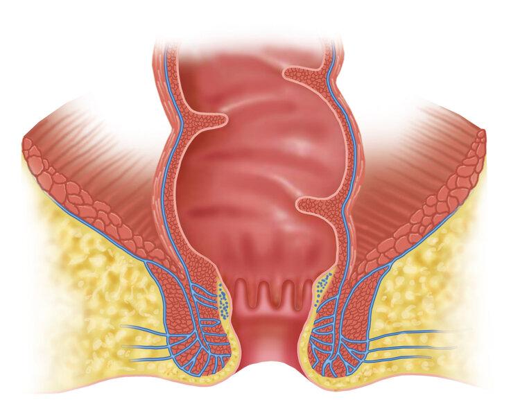肛门处总长小肉球肉疙瘩怎么回事,肛门长小肉球肉疙瘩是怎么了