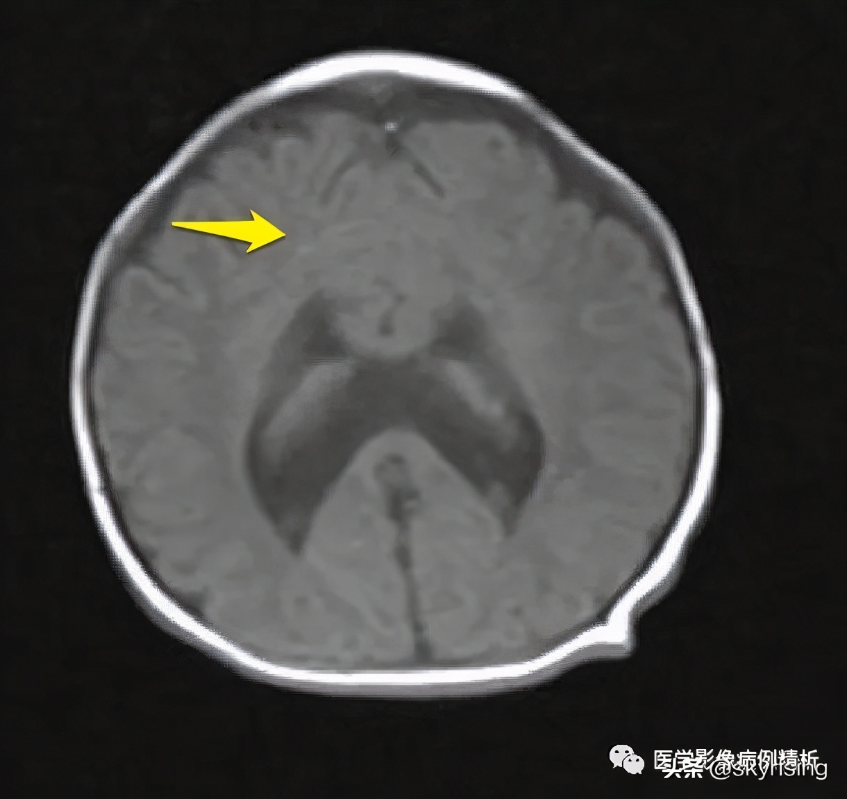 半叶全前脑畸形,无叶型前脑无裂畸形超声表现