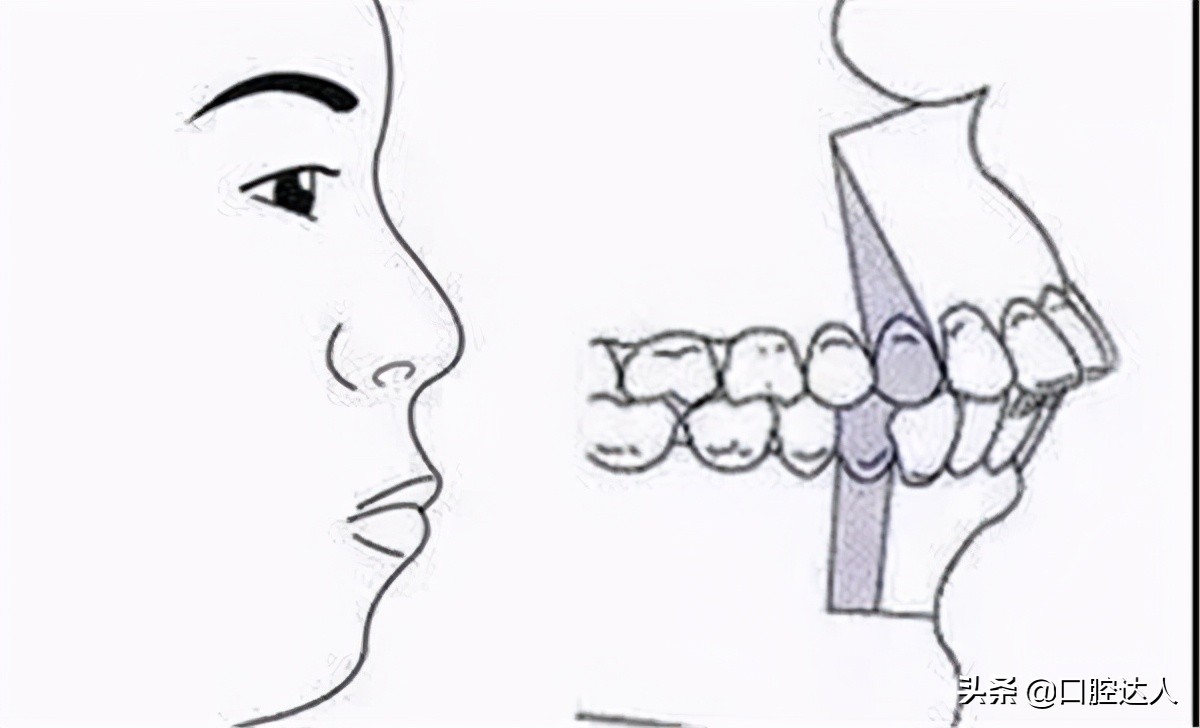 牙齿深覆合怎么判断严不严重,牙齿深覆合是什么样子