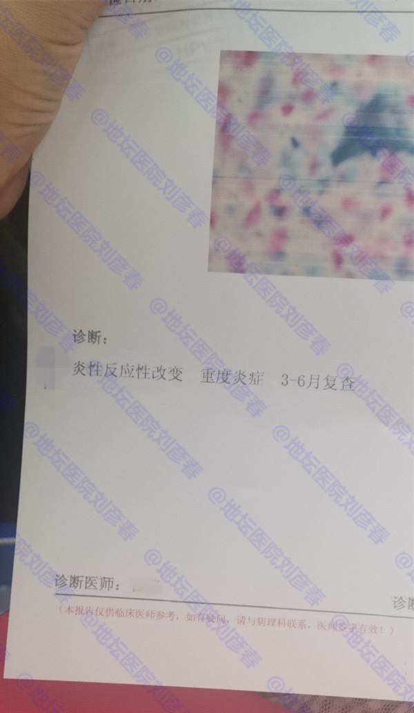 tct重度炎症用什么药治疗,TCT报告显示有炎症