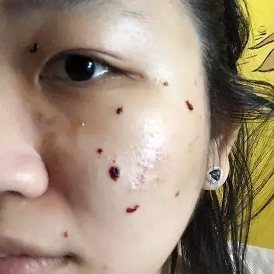 激光祛痣怎么好得快不留疤,激光祛痣亲身经历和感受