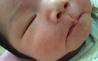 为什么脸上总反反复复长脂肪粒,脂肪粒反反复复怎么办