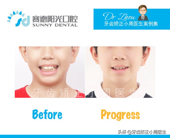 下巴后缩整容玻尿酸还是假体,如何不靠整容改变下巴