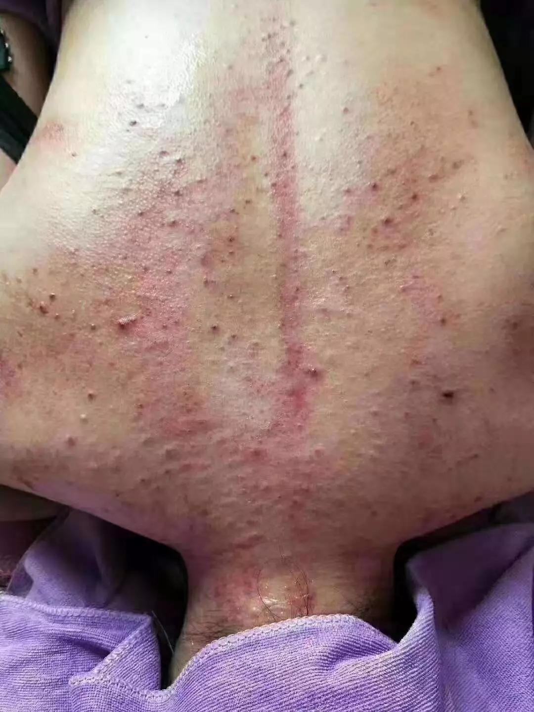 背部湿气重长痘怎么办,作息不规律后背长痘