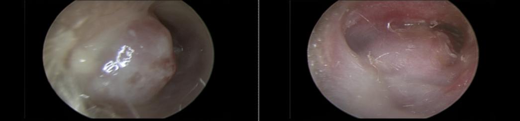 感冒哮喘用药不缓解,吃感冒药诱发哮喘