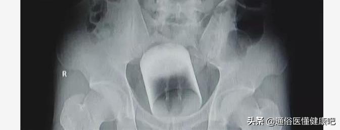 少年血尿是什么原因引起的,少年血尿是怎么回事