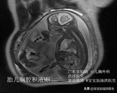 还没生就溢乳是什么导致的,还没生就流虚汗