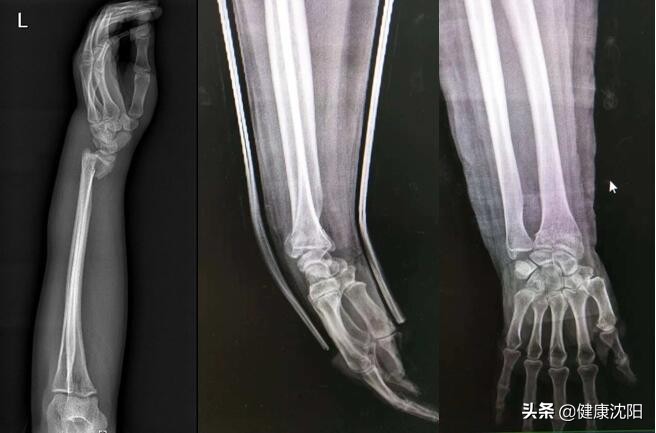 健康科普知识常见骨折防御知识,桡骨远端骨折健康宣教科普知识