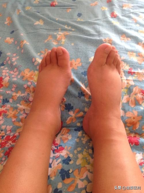 水肿之后减肥减得快吗,长期减肥不瘦怎么办