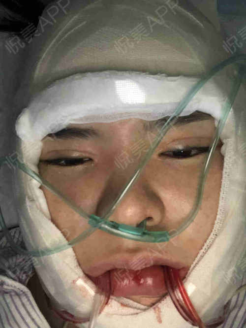 哪个明星做了颧骨内推,颧骨内推明星前后对比