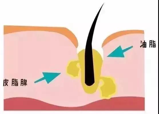 痘痘反反复复试试这招祛痘不用愁,青春期去除痘痘最有效的祛痘神器