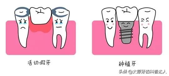 活动假牙和种植牙的性价比,门牙缺失种植牙好还是活动假牙好