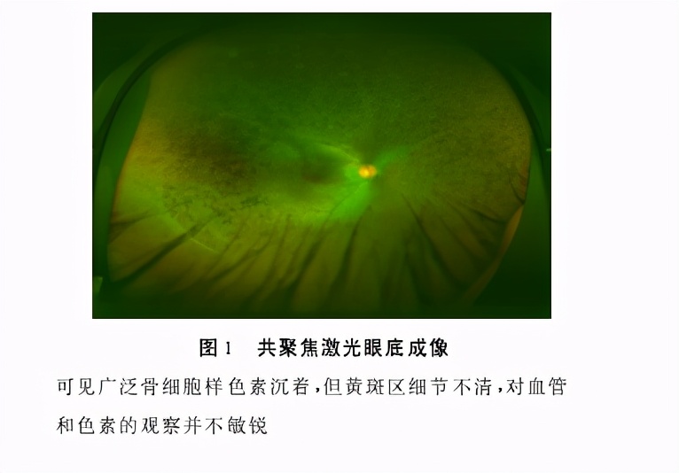 视网膜色素变性是一种常见眼病吗,视网膜色素变性是什么病