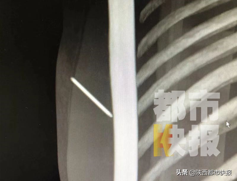 老人胳膊上有鼓包,老人胳膊起包了怎么回事