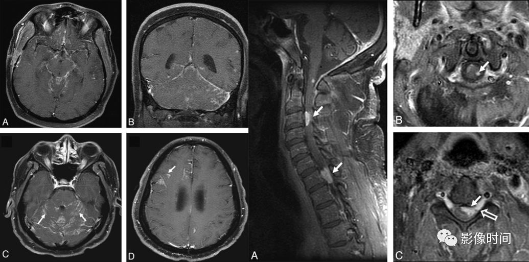 脊髓病变案例图文问诊,脊髓病变视频