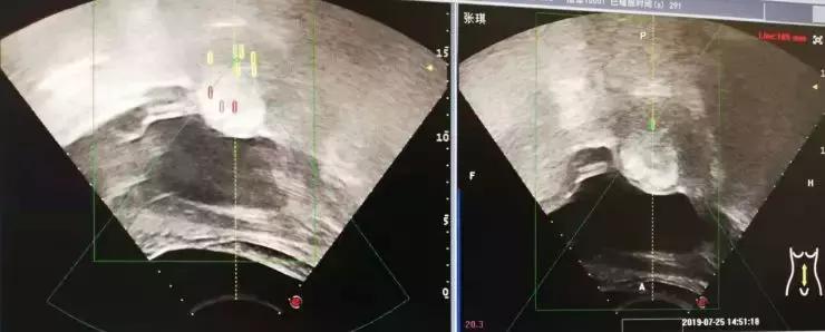 赞！不开刀不流血就把手术做了，赤峰市肿瘤医院迈入微无创时代