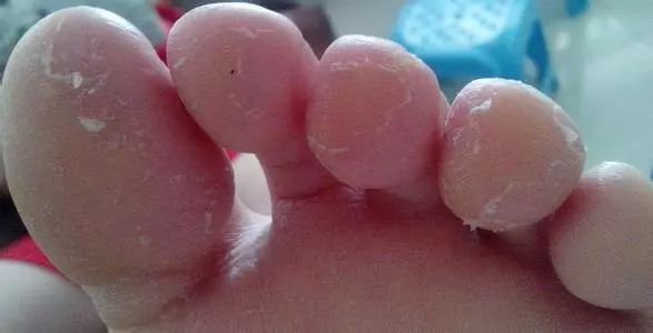 彻底解决脚臭的小妙招,夏天脚臭太尴尬教你一招