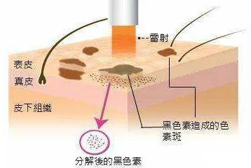 褐斑和雀斑怎么区别,有黄褐斑雀斑要如何保养才能淡化