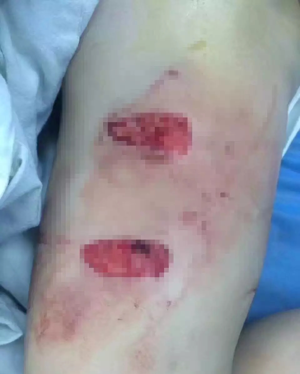 春季以来被猫狗咬伤患者增多，专家提醒应及时接受专业处置