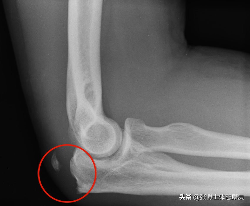 运动肘关节常见创伤及治疗方法,怎么预防肘关节康复二次损伤