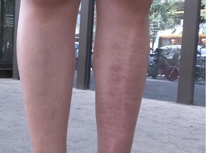 激光脱毛99元6次是真的吗,激光脱毛有疤痕吗