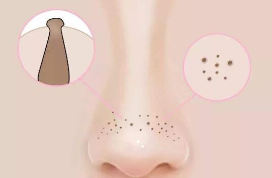 【鼻子最容易挤出这些白色的“条状物”，它到底是什么？】