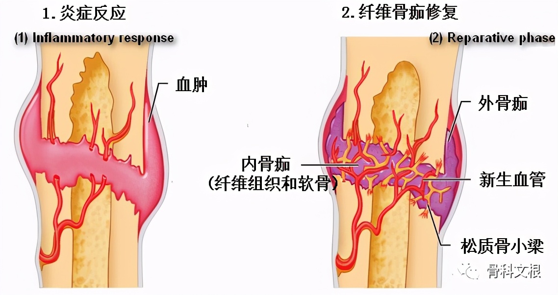 骨折了怎么一直不消肿吃什么药,骨折延缓愈合和骨不连的区别在哪